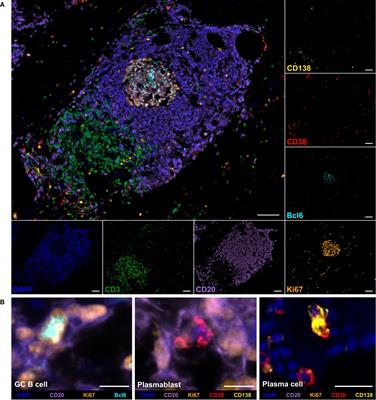 Neoadjuvant chemotherapy is associated with suppression of the B cell-centered immune landscape in pancreatic ductal adenocarcinoma